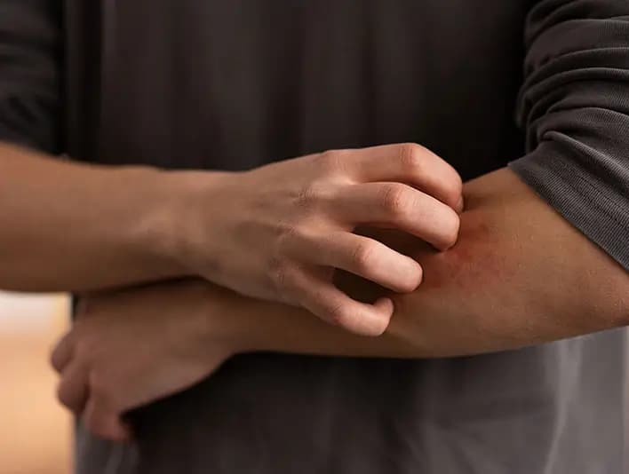 Get Online Treatment for Eczema in Men