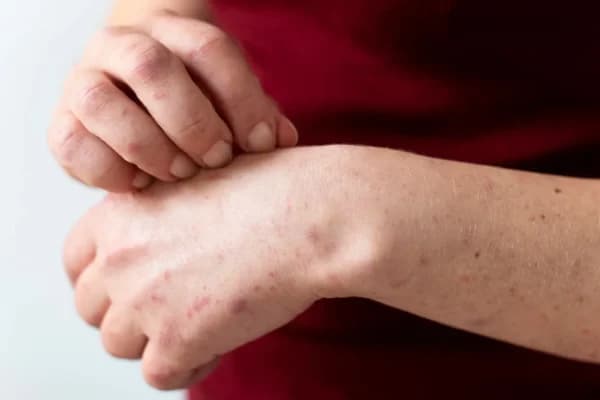 Eczema